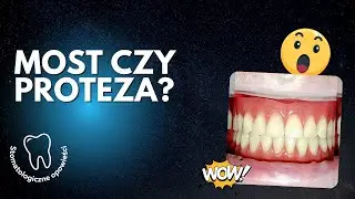 Most czy proteza - co wybrać? I dr Rawicki #stomatolog #stomatologbydgoszcz