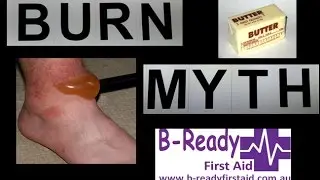 Burn Myths by B Ready First Aid