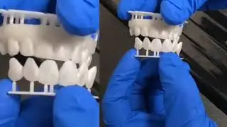 Dental Veneers with NemoSmile Design