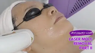 Laser Hair Removal Diode Laser Hair Removal 808nm Laser Painless -myChway GX002 Part II Face