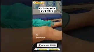 Fixed flexion deformity - knee osteoarthritis | Dr Sunil Tank #kneepain #kneearthritis #kneerepair