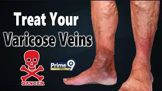 Treat Your Varicose Veins - It's Very Dangerous | Prime9 Digital
