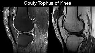 Gouty Tophus of Knee