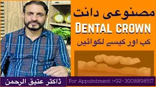 Fixed Teeth Crown &ndash; When and How They Are Place