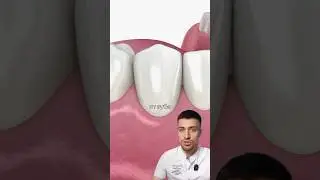 Как НАРАЩИВАЮТ десны? #рецессиядесны #стоматология #десна
