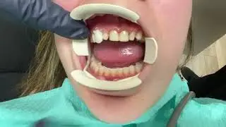Houston Cosmetic Dentist... Step by step placement of Minimal Prep Porcelain Veneers...