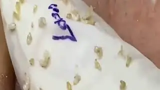the worst gigantic blackhead removal