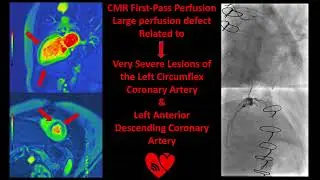 CMR first-pass Perfusion: Large perfusion defect related to CX & LAD severe lesions