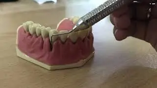 UNC -15 perio probe | checking the pocket depth, Clinical attachment loss and gingival recession