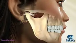 TMJ Occlusional Splint