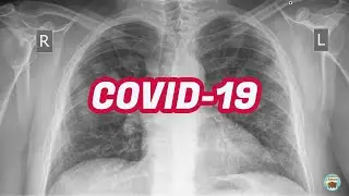 Chest X-rays findings in COVID-19 patients