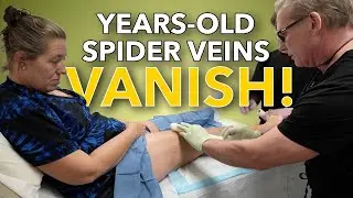 Watch As Years-Old Spider Veins Disappear Before Her Eyes! 👀