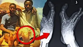 Zimbabwe Tribe With Two Toed  Ostrich Feet