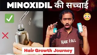 Why I&rsquo;m NOT Using Minoxidil? Full Truth EXPLAINED.