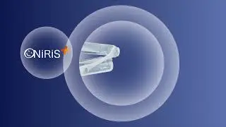 ONIRIS PLUS&reg; &ndash; Orth&egrave;se d'avancement mandibulaire &ndash; Traitement du ronflement et de l&rsquo;apn&eacute;e du sommeil