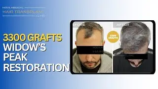 3300 Grafts Hair Transplant | Widow&rsquo;s Peak Restoration with Natural Results