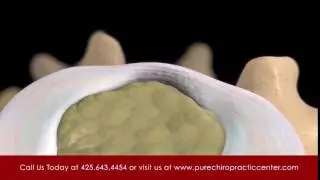 PureChiropractic 7SecondBumper Decompression 3