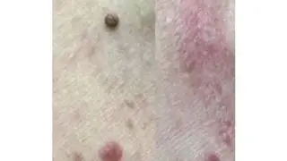 Skin Tag Removal