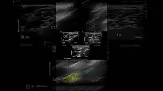 Is it possible to reliably identify ventral rami using ultrasound? #anatomy #regionalanesthesia