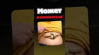 Может ли развязаться пупок ❓