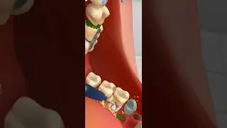 ASMR Infected Teeth &Warm Infected Teeth Deep Cleaning #shorts #skincare #asmr #infectedtreatment