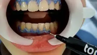 Using FGM Whiteness HP Maxx For In Office Bleaching Tooth Whitening