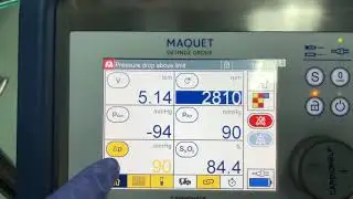 Ecmo troubleshooting P1