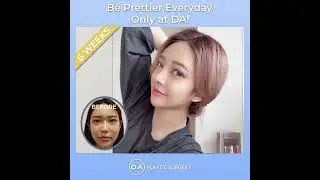 [Before and After] Amazing Plastic surgery in Korea at Real Review only possible by DA Clinic
