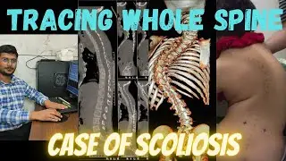 How to trace CT Scan Whole Spine | How to make Curved images in GE Revolution#radiologytechnologist