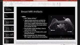 MRI BREAST ARTIFACTS