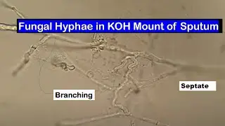 Observation of Septate Branching Fungal Hyphae in KOH Mount of Sputum Sample