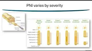 Injury Specific Effect of Schwann Cell-Derived Exosome Treatment for Peripheral Nerve Injury