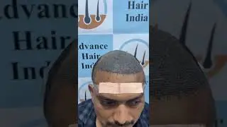 | Advance Hair India | Hair Transplant | Hair Style |