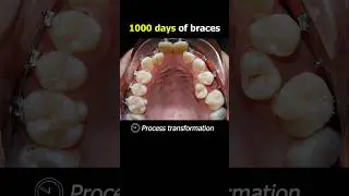 1000 days of braces. Fix crooked and   buck teeth #braces #orthodontist #dentist #teeth