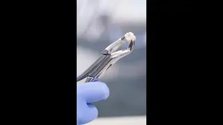 Do you get all of your Teeth Extracted on the same day as getting Dental Implants?