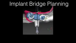 For Dentists only! - Part 1 - Dental Implant Planning Session Molar bridge