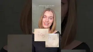 Раньше я ОЧЕНЬ боролась с прыщами 🫠 сейчас их почти нет 🤍 #акне #следыотпрыщей #кожасклоннаякпрыщам