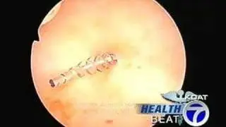 Heathbeat - Essure Procedure Alternative to Tube Tying