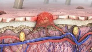 Melanoma: The Most Serious Type of Skin Cancer