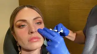 Tear trough filler with Dr Calobrace