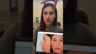 3 Months Postoperative Rhinoplasty Result - Prominent Bump Nose | Anthony Bared, MD, FACS Miami, FL