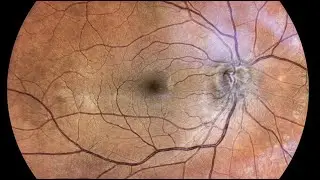 Radiation-Induced Optic Neuritis: Treatment Options and Considerations