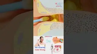 Ear Wax Cleaning by Cotton Swab 👂 Gone Wrong!