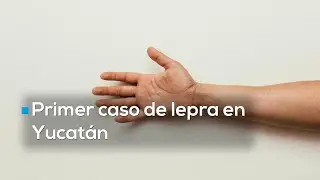 &iquest;Qu&eacute; es la lepra? Yucat&aacute;n confirma primer caso en 2025