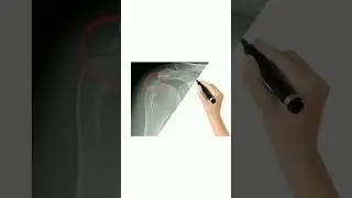 MSD - Calcium tendinopathy X Ray image #anatomy #xray #medical students
