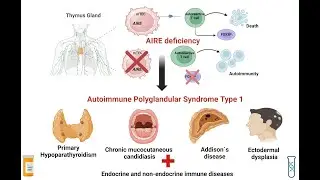 Polyglandular Syndrome Or Autoimmune Polyglandular Syndrome APS,multiple endocrine glands are affect