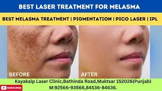 Best Laser Treatment for Melasma | Best Melasma Treatment | Pigmentation | Pico Laser | IPL