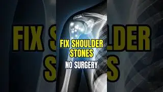 Calcific Tendinitis Of The Shoulder? Extracorporeal Shock Wave Therapy May Be The Solution!