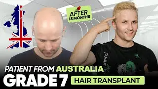 Hair Transplant in Kochi  | Best Results & Cost of Hair Transplant in Kochi