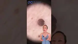 Fibromas Blandos
